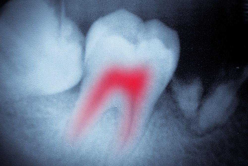 Illustration of inflamed root canal in x-ray