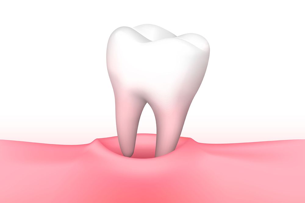 Illustration of tooth extraction