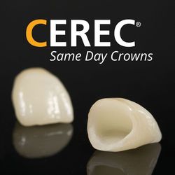 Photo of CEREC crowns