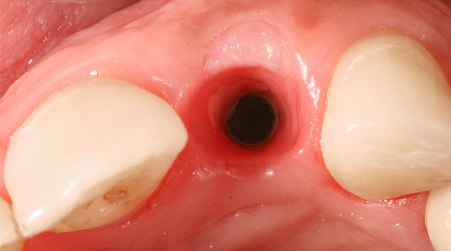 The area of the gum where a tooth extraction has occurred.