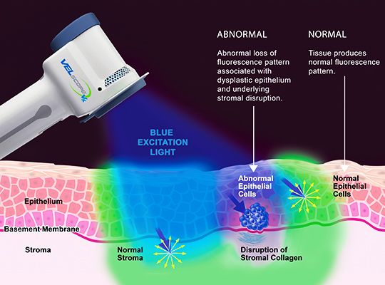 image of VELscope